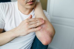 Is There A Link Between Arthritis and Skin