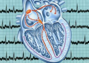 What is Atrial Fibrillation (AFib)