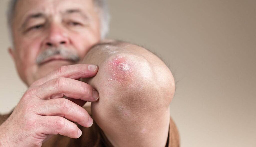 arthritis and skin issues