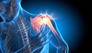 Lifestyle Changes to Manage Shoulder Arthritis
